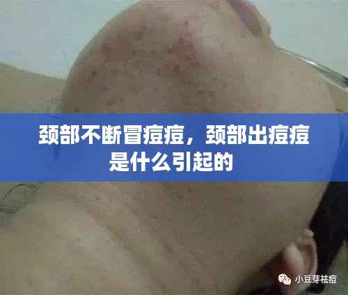 颈部不断冒痘痘,颈部出痘痘是什么引起的